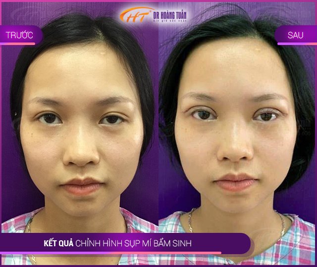 Kết quả sửa sụp mí tại Thẩm mỹ Hoàng Tuấn